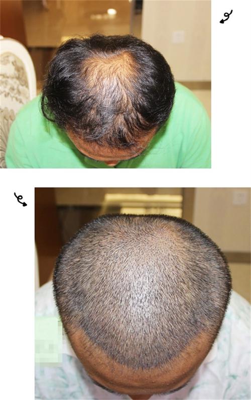 m型发际线怎么补救_M型发际线成因及改善方法