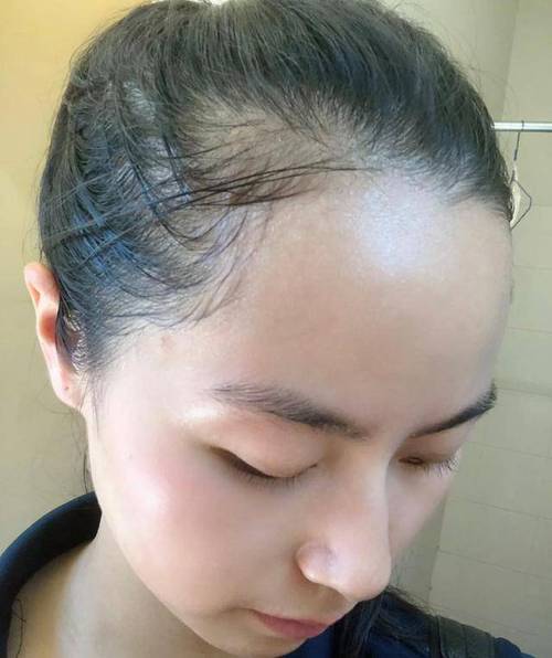 扎低马尾会导致发际线后移吗_低马尾伤发际线?扎发频率和松紧是关键 扎低马尾会导致发际线后移吗_低马尾伤发际线?扎发频率和松紧是关键