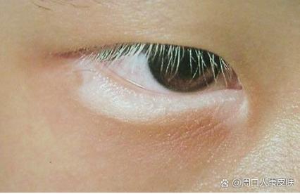 睫毛发白是什么原因导致的_睫毛变白原因及应对方法 睫毛发白是什么原因导致的_睫毛变白原因及应对方法