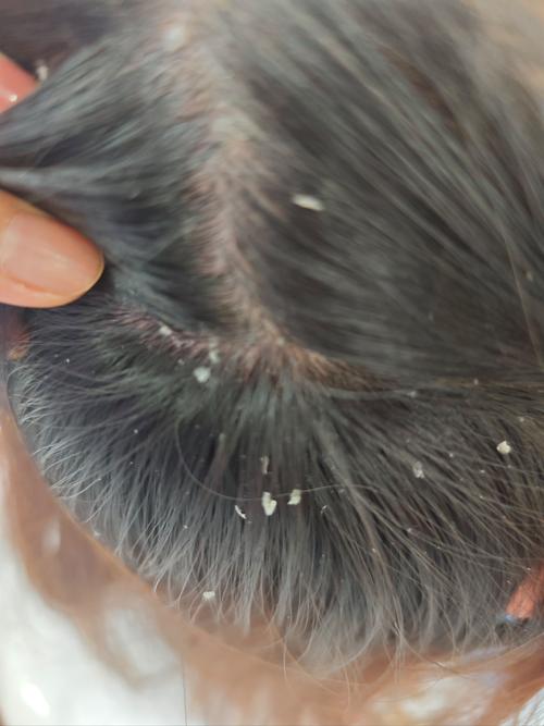 烫完头发掉头皮屑正常吗_烫发头屑多?刺激屏障失衡惹的祸! 烫完头发掉头皮屑正常吗_烫发头屑多?刺激屏障失衡惹的祸!