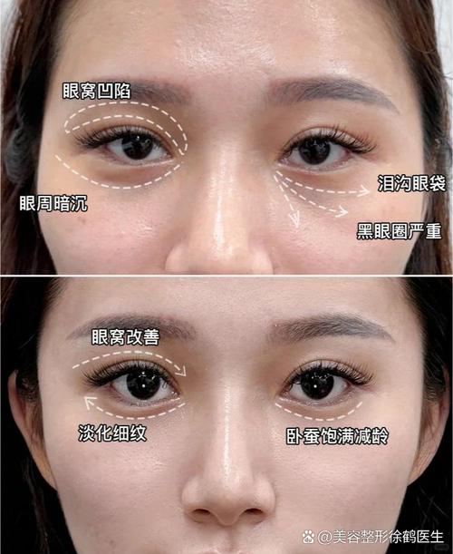 眼窝凹陷怎么恢复饱满的方法_填充按摩选对法 眼窝凹陷怎么恢复饱满的方法_填充按摩选对法