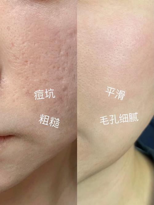 痘坑化妆怎么遮盖_粉底遮瑕巧遮痘印，护理医美助淡化