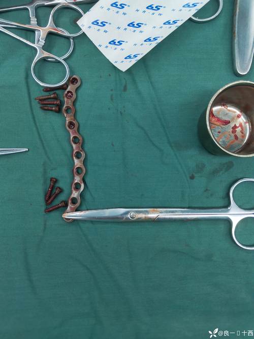 锁骨内固定器械_恢复行动，重获自由