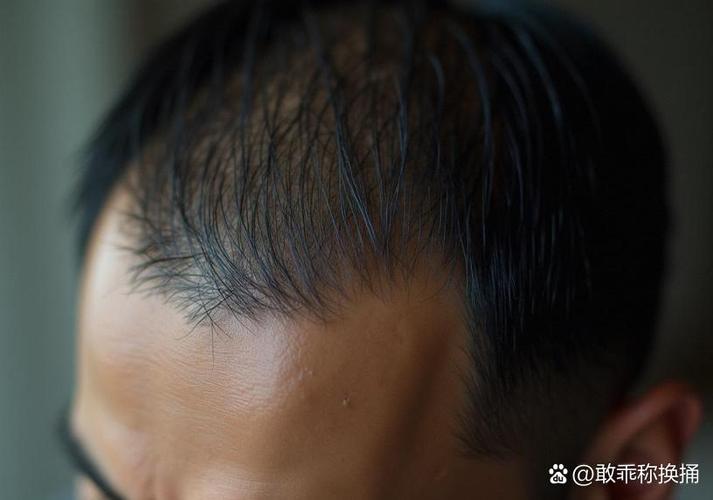 一摸头发头皮就针扎似的疼_头皮触痛怎么办? 一摸头发头皮就针扎似的疼_头皮触痛怎么办?