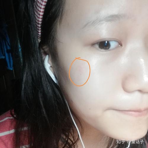 被卷发棒烫了会怎么样_卷发棒烫伤处理及疤痕预防 被卷发棒烫了会怎么样_卷发棒烫伤处理及疤痕预防