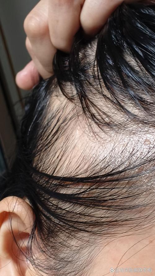 三天洗一次头掉200根头发正常吗_掉头发多怎么办? 三天洗一次头掉200根头发正常吗_掉头发多怎么办?