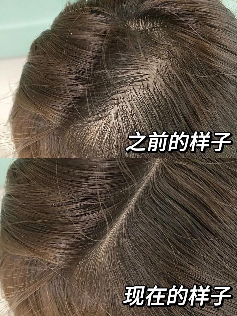 稍微一扎头发就头皮疼_扎头过紧痛?松松绑,头皮爽! 稍微一扎头发就头皮疼_扎头过紧痛?松松绑,头皮爽!