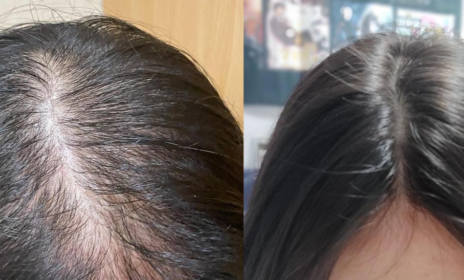 掉下来的头发没有发根_脱发没根?查生活习惯,看医生! 掉下来的头发没有发根_脱发没根?查生活习惯,看医生!