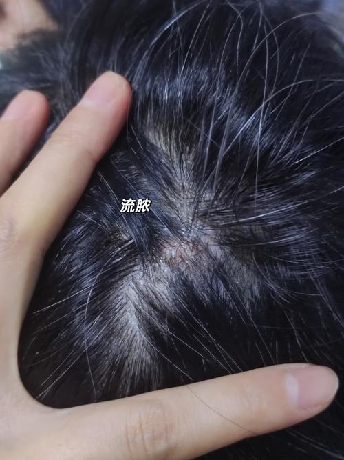 摸头发头皮像针刺样痛_摸头头皮刺痛?原因和处理方法 摸头发头皮像针刺样痛_摸头头皮刺痛?原因和处理方法