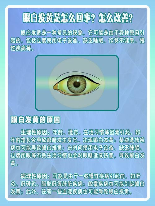 眼白发黄是什么原因_眼白发黄?多注意生活习惯和体检! 眼白发黄是什么原因_眼白发黄?多注意生活习惯和体检!