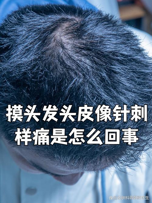 一碰头发感觉头皮疼，摸起来又不疼_头发扎紧头皮疼？别大意！