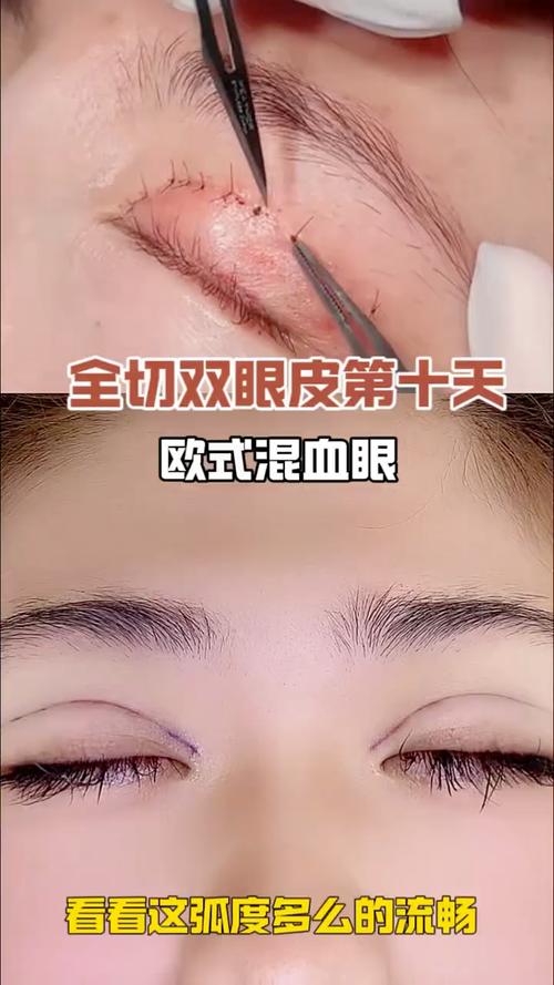 全切双眼皮术后多久可以化妆_全切双眼皮术后多久能化妆? 全切双眼皮术后多久可以化妆_全切双眼皮术后多久能化妆?