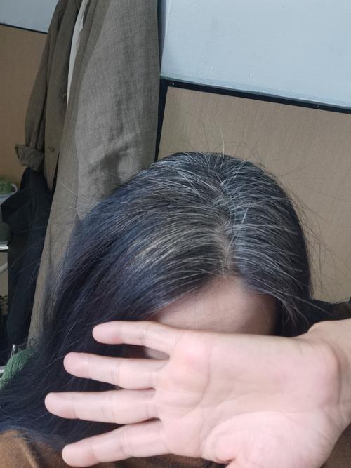 前刘海一绺头发变白_白发多?查营养防压力! 前刘海一绺头发变白_白发多?查营养防压力!