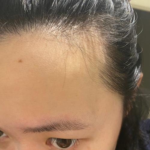 命理发际线两侧额角没头发_额角脱发多因啥?调整饮食作息是关键 命理发际线两侧额角没头发_额角脱发多因啥?调整饮食作息是关键