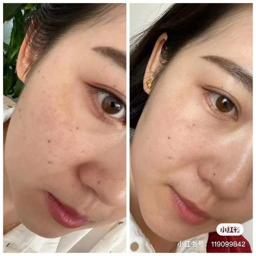 做过激光的脸适合用那种化妆品_激光后皮肤敏感？温和清洁修复防晒很重要！