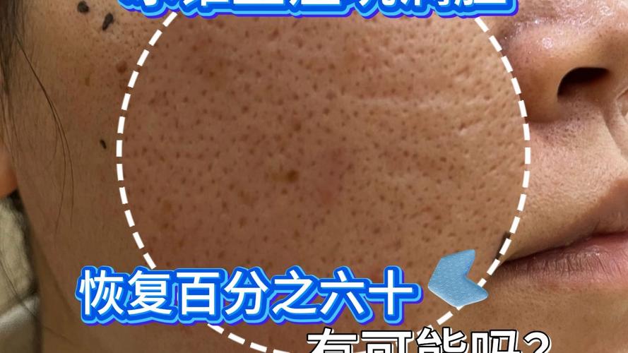 冰锥痘坑能被化妆品遮盖吗_冰锥痘坑怎么办?医美改善效果佳 冰锥痘坑能被化妆品遮盖吗_冰锥痘坑怎么办?医美改善效果佳