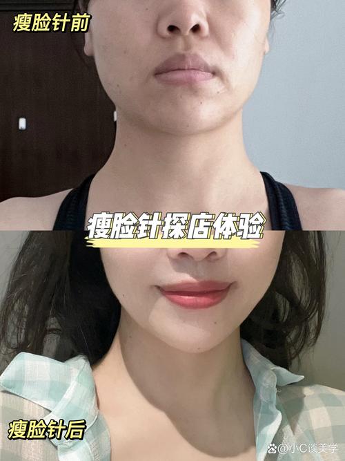 打完瘦脸多久可以化妆_瘦脸针注射后多久见效？注意事项解析