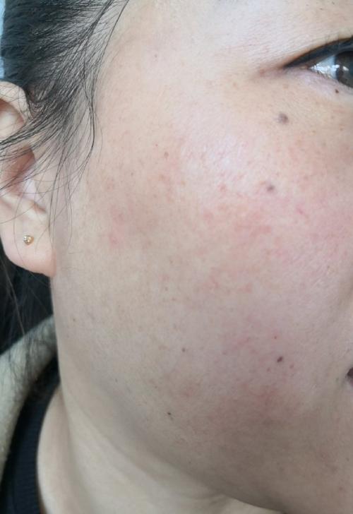 用完化妆品脸发红长红点_化妆品过敏红肿？停用清洁加舒缓！