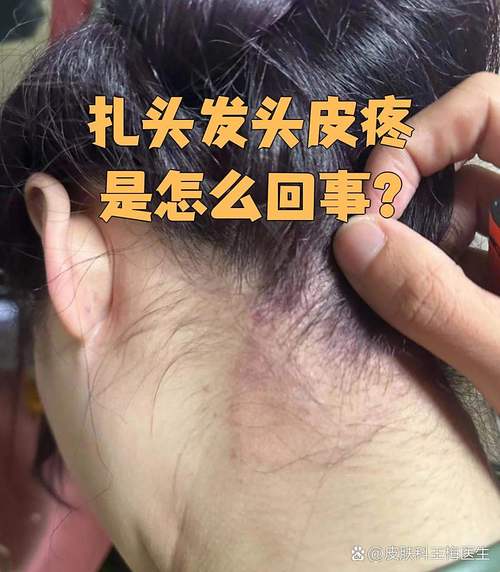 半边头皮疼痛一摸头发就痛_半边头皮疼？神经痛或感染找上门