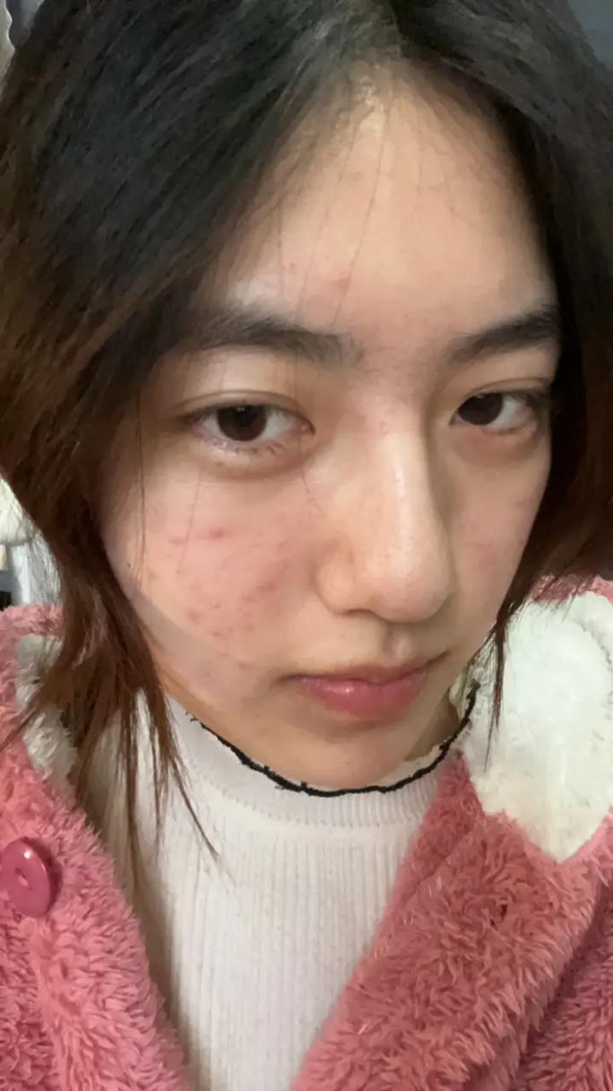 痘痘没消干净能化妆嘛_不干净化妆加重痘痘?正确护理告别痘痘! 痘痘没消干净能化妆嘛_不干净化妆加重痘痘?正确护理告别痘痘!