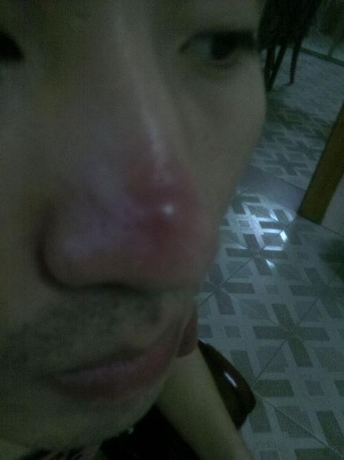 用完化妆品鼻子上起了一个包_鼻子红肿？查查化妆品过敏！