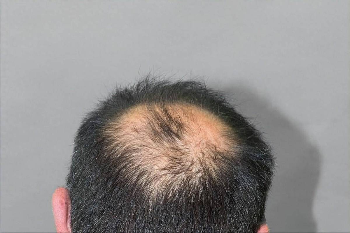 老掉头发_脱发原因多，调整生活习惯或可改善