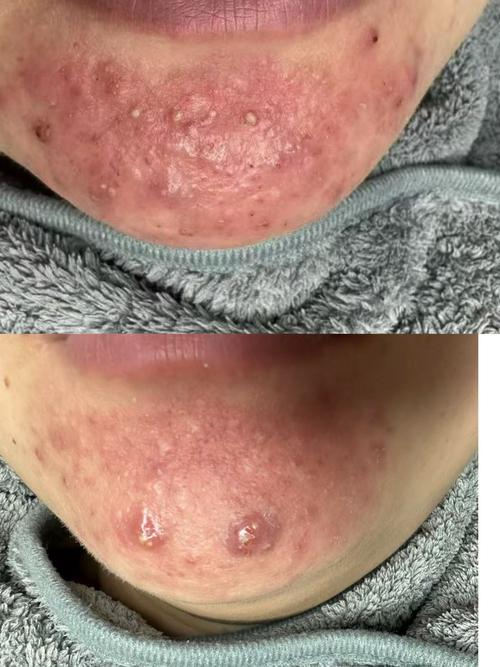 痘痘挤破了还能化妆吗_挤痘痘后别马上化妆,等它好再涂! 痘痘挤破了还能化妆吗_挤痘痘后别马上化妆,等它好再涂!