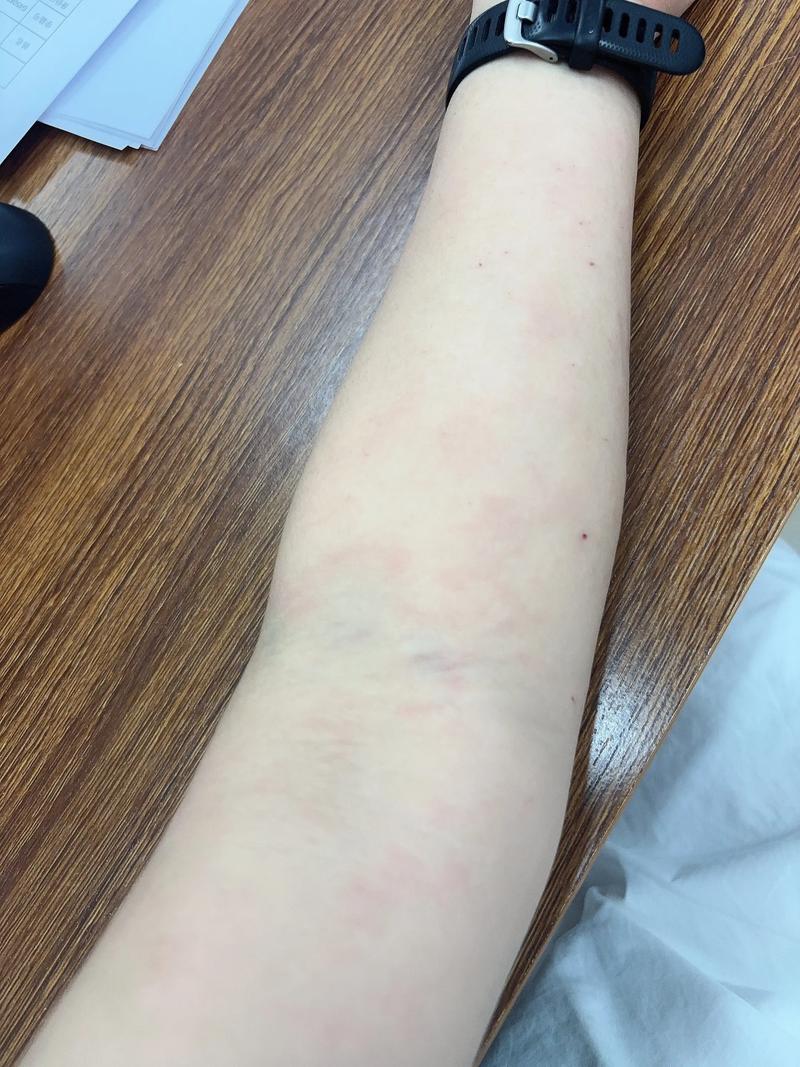 过敏能锻炼吗_春季过敏?室内温和运动,户外选对时机! 过敏能锻炼吗_春季过敏?室内温和运动,户外选对时机!