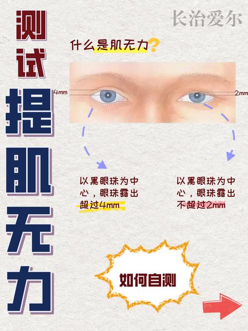 上眼皮肌无力怎么锻炼_上睑下垂锻炼恢复视功能 上眼皮肌无力怎么锻炼_上睑下垂锻炼恢复视功能