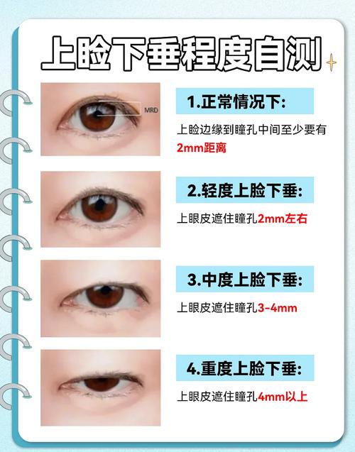 上睑提肌无力怎么锻炼_上睑提肌无力锻炼与手术矫正