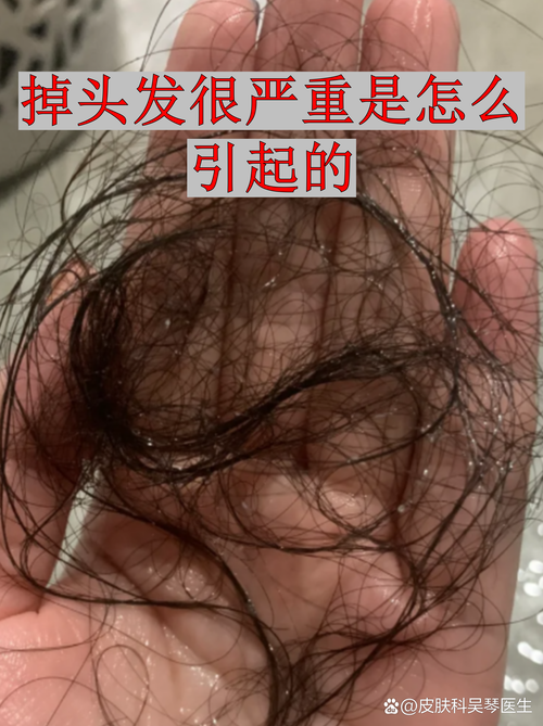 轻轻一扯就掉头发正常吗_脱发多？看这原因和怎么办