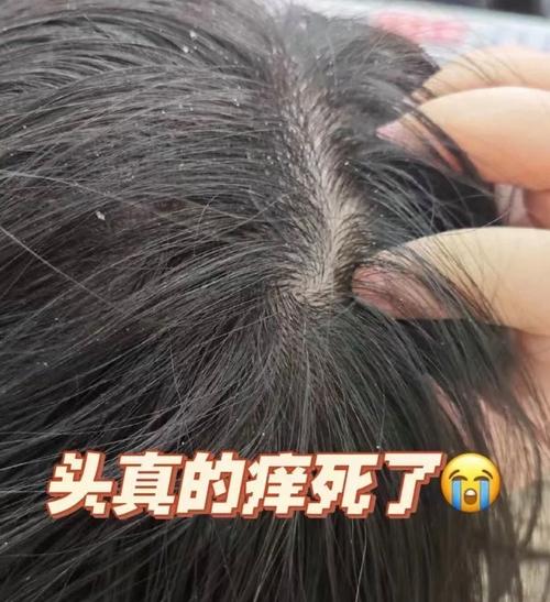 昨天刚洗头发今天就头痒_头皮痒？查查原因，温和护理是关键！