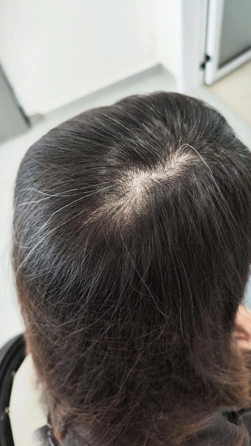 突然有一根白头发正常吗_偶尔白发不用慌，遗传熬夜都有关，密集需看医生