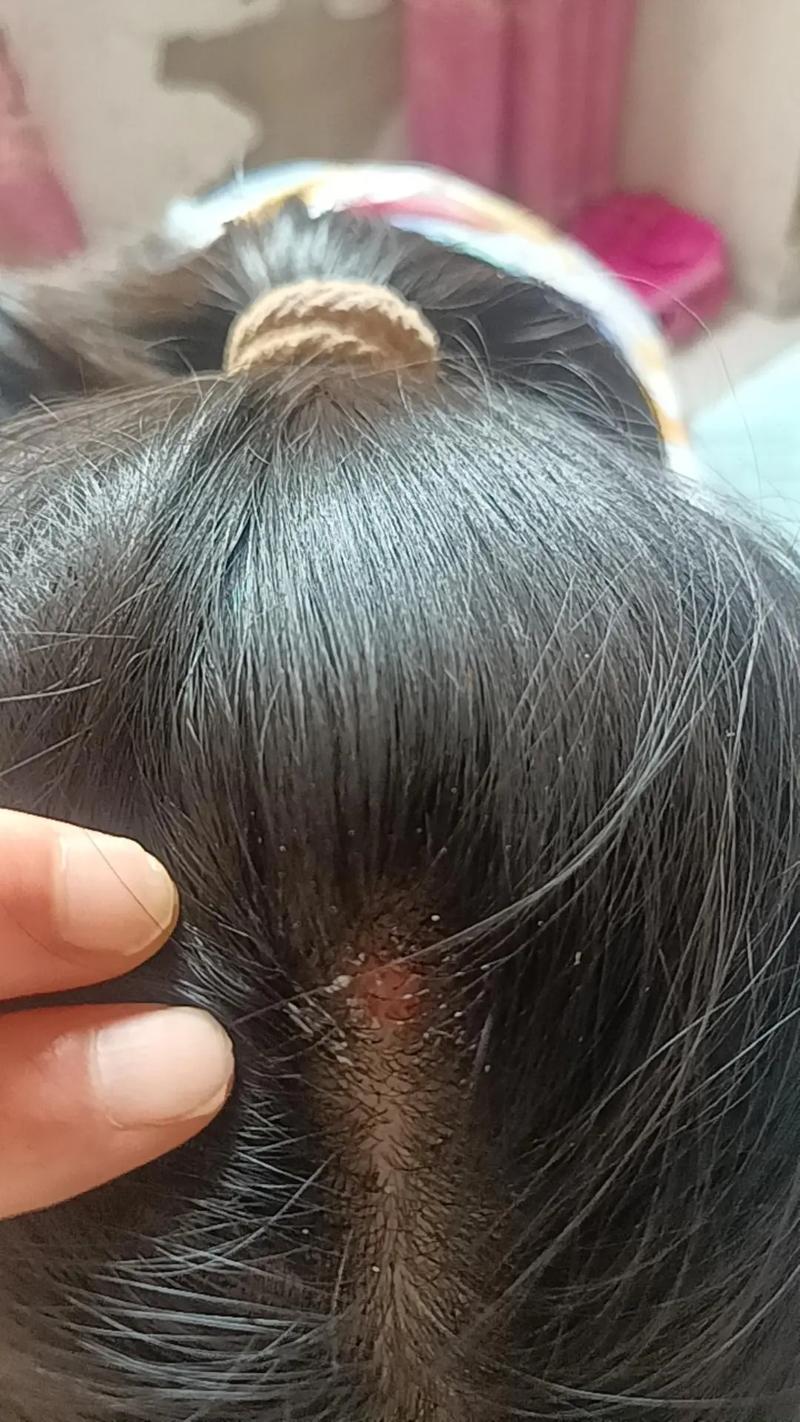 用力扯头发掉了还会长吗_毛囊断了还会长，营养作息很重要