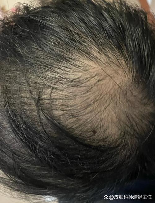 遗传性头发稀少又软又少_遗传脱发软稀?基因敏感是主因,营养作息也重要! 遗传性头发稀少又软又少_遗传脱发软稀?基因敏感是主因,营养作息也重要!