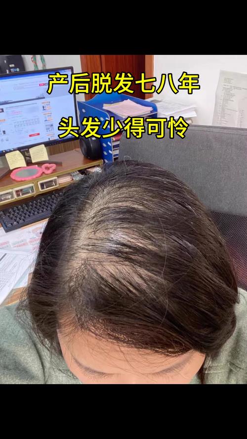 左边头发比右边稀少_左边头发稀少?遗传生活习惯都可能是原因 左边头发比右边稀少_左边头发稀少?遗传生活习惯都可能是原因