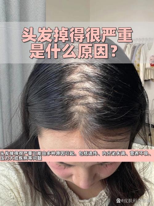 甲醛超标会掉头发吗_甲醛超标危害大，通风选环保很重要！