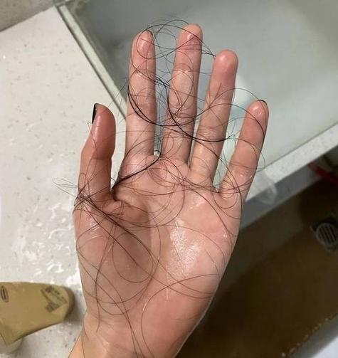 疯狂掉头发一抓就一把_压力大 营养差伤发,脱发及时就医 疯狂掉头发一抓就一把_压力大 营养差伤发,脱发及时就医