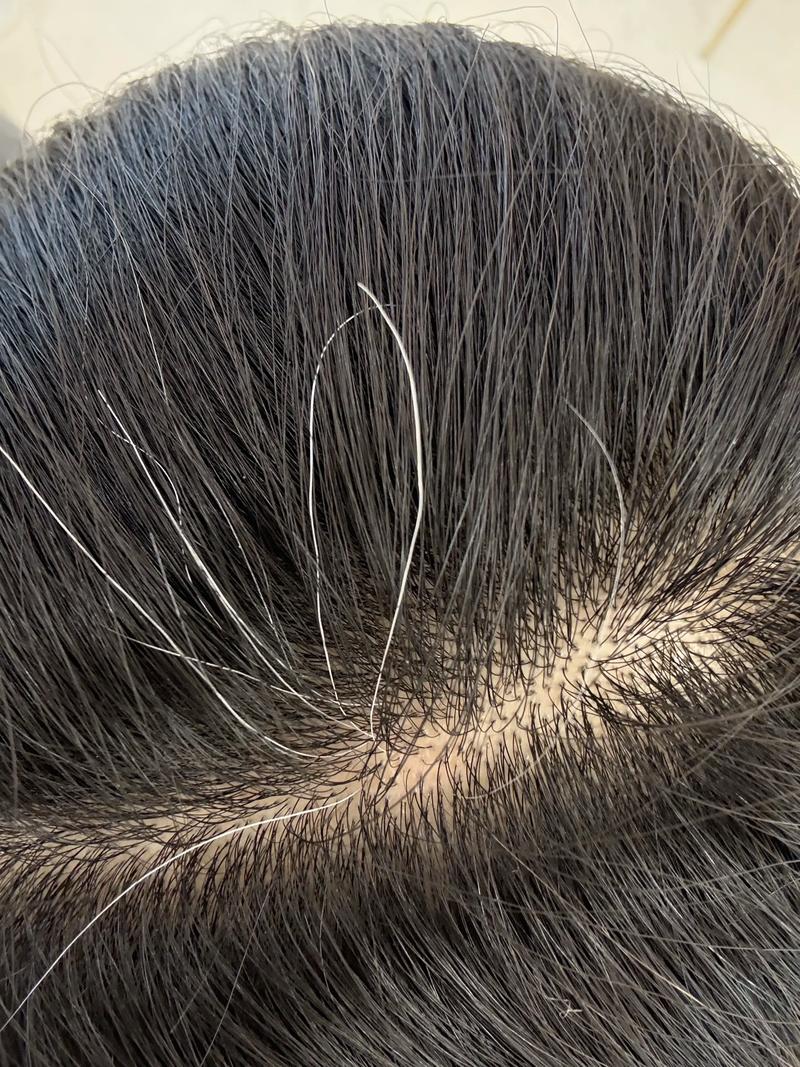 把白头发拔了会有什么后果_别拔白发！伤毛囊还可能更糟