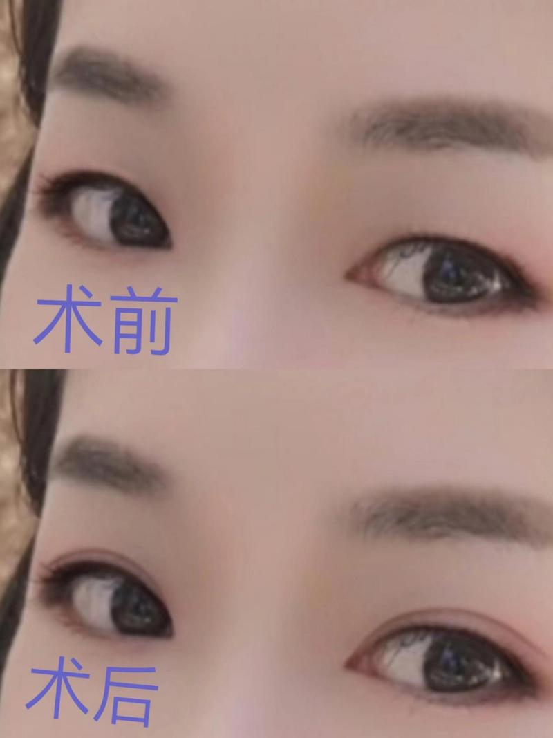 割了双眼皮多久能化妆_双眼皮恢复快慢及化妆要点