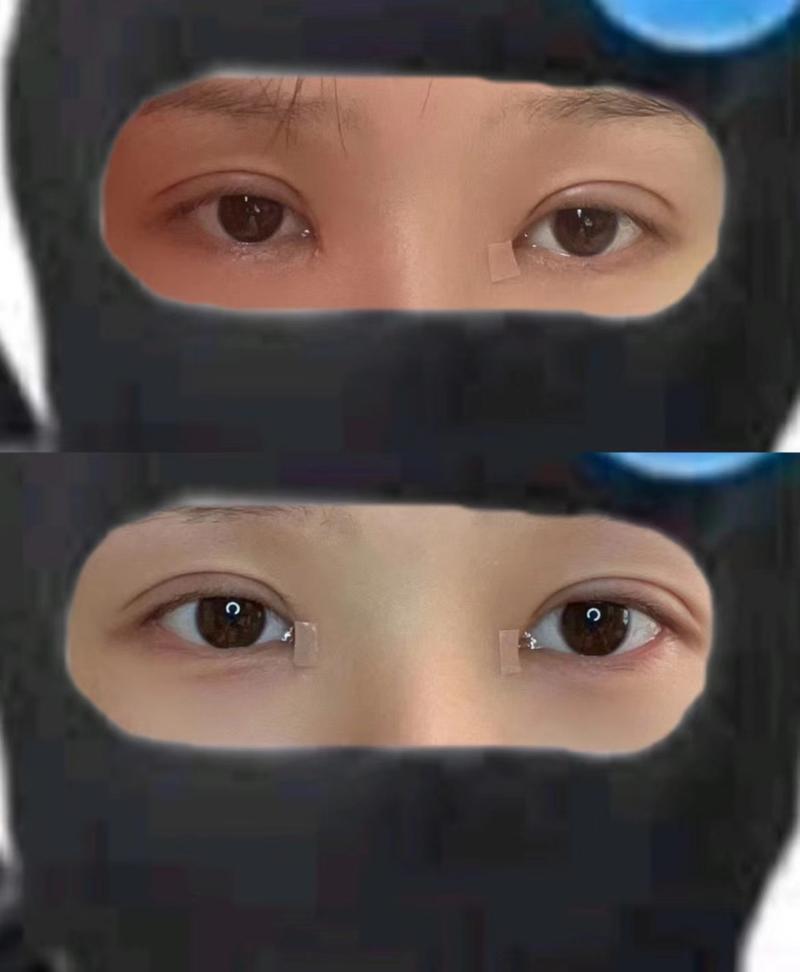 切完双眼皮多久能化妆_双眼皮恢复期化妆禁忌与注意事项