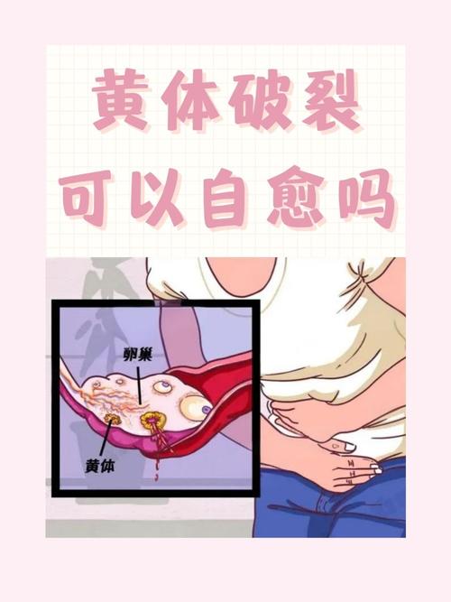 胆黄体破裂是什么情况_胆黄体破裂别混淆,腹痛及时就医是关键! 胆黄体破裂是什么情况_胆黄体破裂别混淆,腹痛及时就医是关键!