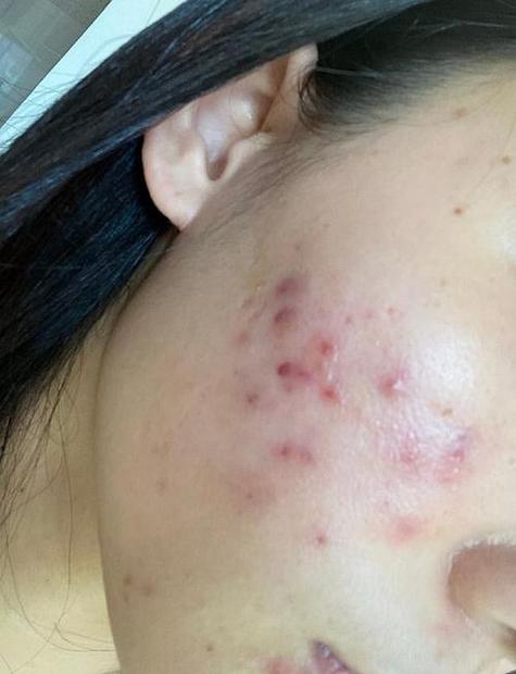 破口痘痘愈合时能化妆吗_痘痘未愈莫化妆,防晒饮食助愈合 破口痘痘愈合时能化妆吗_痘痘未愈莫化妆,防晒饮食助愈合