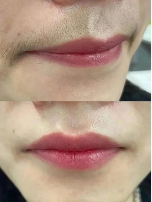 去唇毛永久的最好方法_激光脱毛精准，电解脱毛持久，选对适合你的！