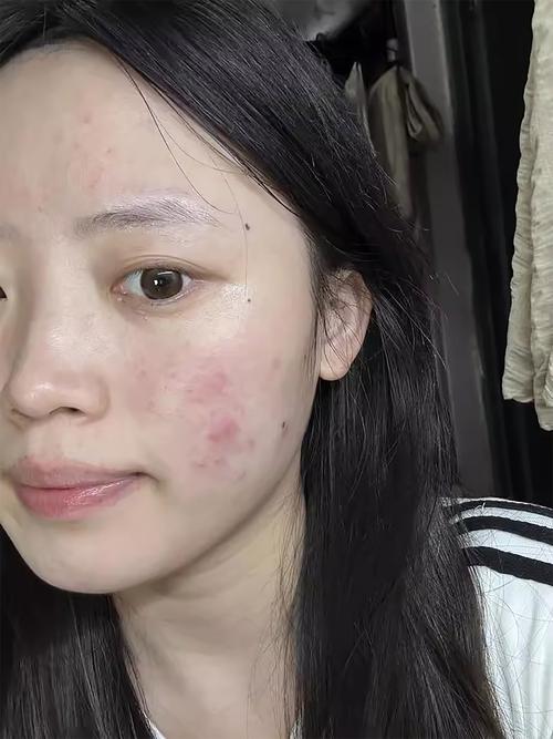 挤过痘痘直接化妆了_挤痘后别马上化妆,等48小时再护理! 挤过痘痘直接化妆了_挤痘后别马上化妆,等48小时再护理!