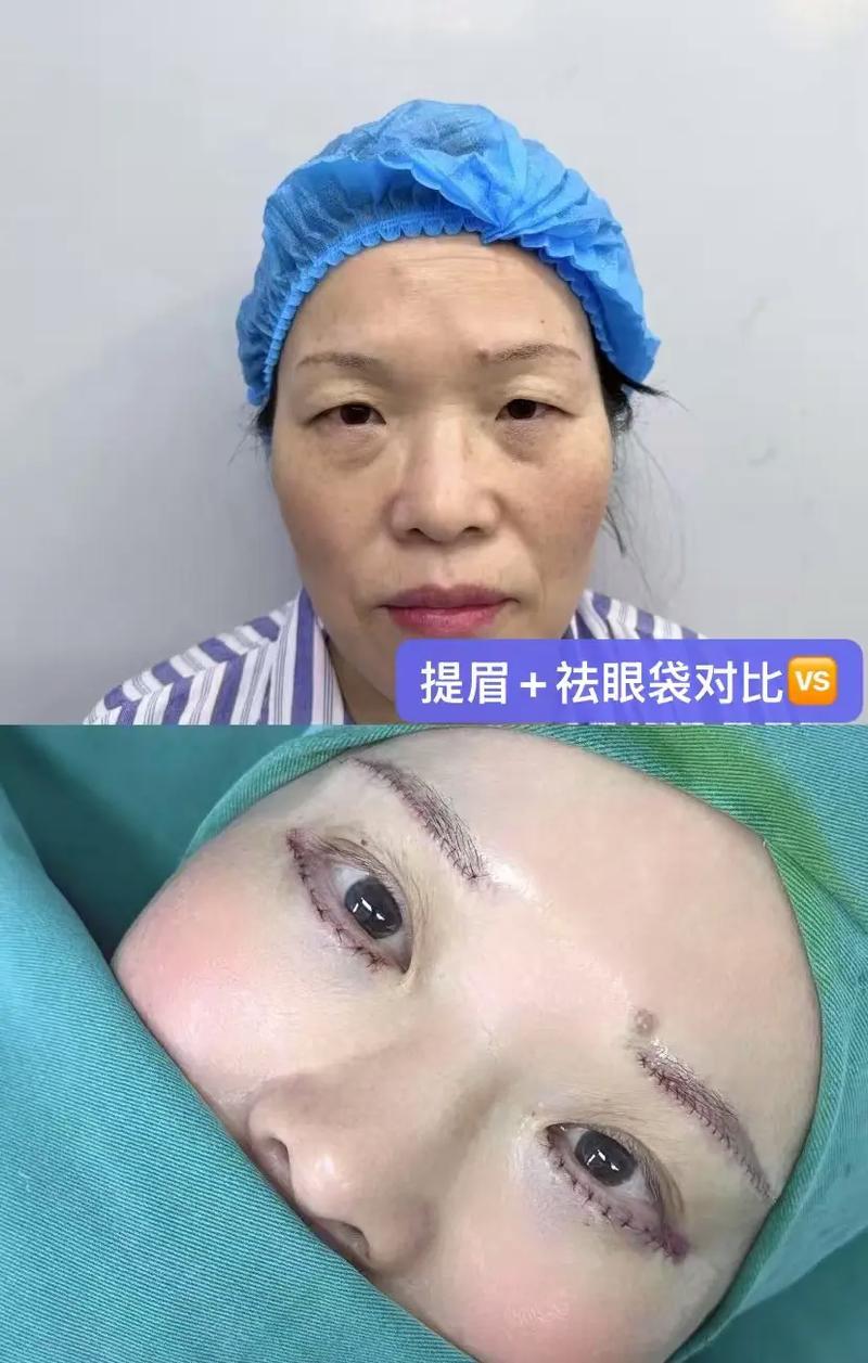 切眉切眼袋几天可以化妆_切眉切眼袋术后多久能化妆？恢复期注意事项