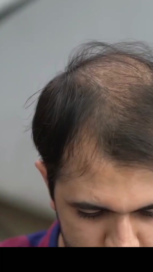 地中海发型一定会遗传吗_地中海脱发遗传？后天也能管！