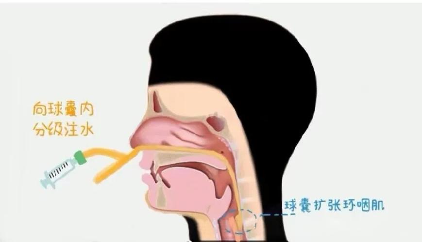 软腭塌陷怎么锻炼恢复_软腭塌陷如何锻炼改善? 软腭塌陷怎么锻炼恢复_软腭塌陷如何锻炼改善?