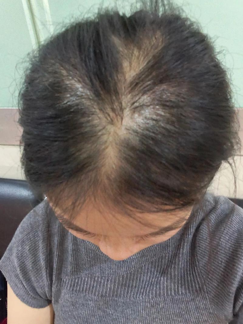 无缘无故少了一块头发_脱发原因多,斑秃真菌缺营养压力大 无缘无故少了一块头发_脱发原因多,斑秃真菌缺营养压力大