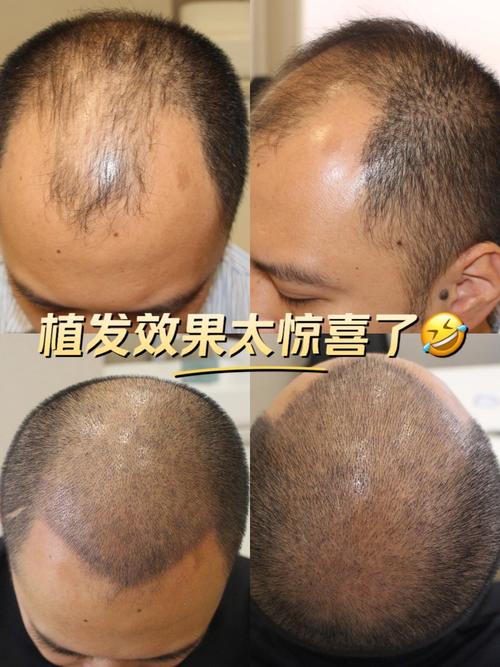 额骨头发稀疏_遗传激素熬夜压力大，脱发稀疏这样救！